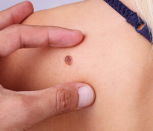 Are There Side Effects of Mole Removal Treatments in Dubai?