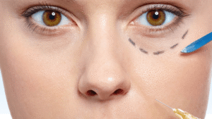 How Under Eye Fillers Can Brighten Eyes and Restore Confidence