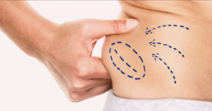Liposuction Recovery Blueprint by Best Liposuction Surgeons in Dubai