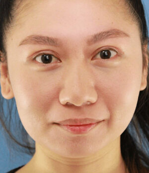 Can Cheek Fat Removal in Dubai Be Reversed if I Don’t Like the Outcome?