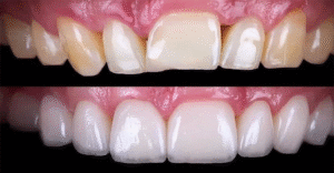 Can Children or Teenagers Get Dental Veneers in Dubai Safely?