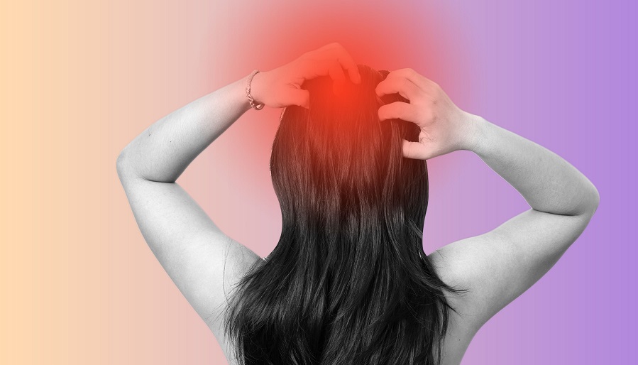 Can a dermatologist treat scalp eczema for fast relief