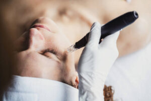 What to Expect During Your First Derma Pen Visit