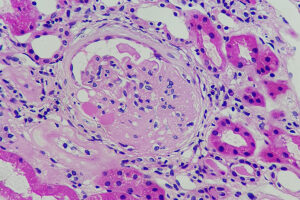 Advances in Immune-Mediated Kidney Therapy and Triggers