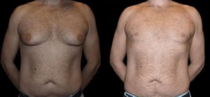 Best Gynecomastia Surgeon in dubai for Life-Changing Results