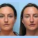 Discover the Secrets Behind Successful Thread Lift Treatment in Dubai