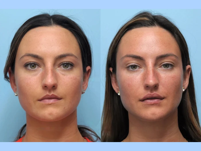 Discover the Secrets Behind Successful Thread Lift Treatment in Dubai