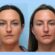 Thread Lift in Dubai: Instant Lifting Results with Minimal Downtime
