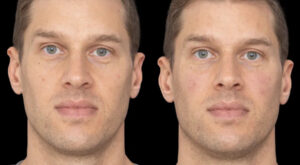 Under Eye Fillers in Dubai