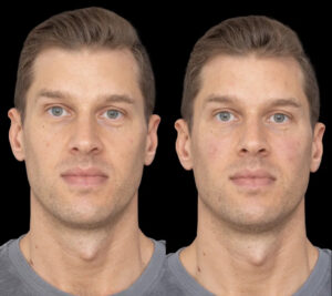 Under Eye Fillers in Dubai