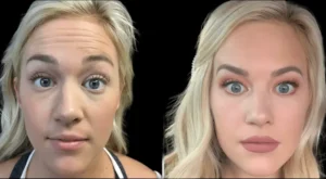 Botox in dubai