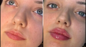 Fillers in Dubai