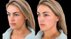 Cheek Fillers in Dubai