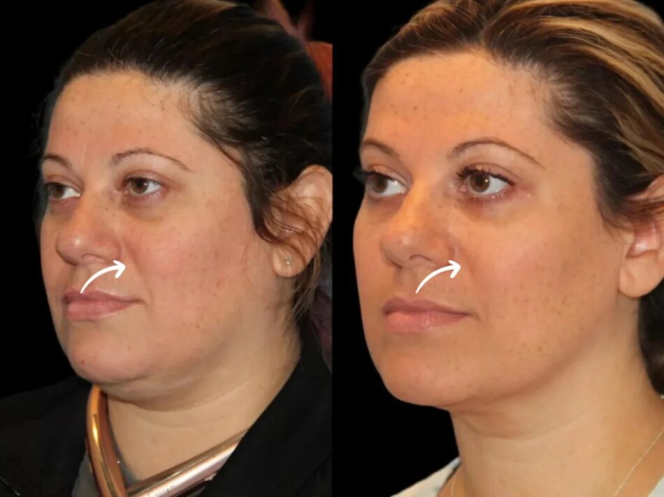 Best Plastic Surgeon in Dubai: Sculptra for Sculpturesque Beauty