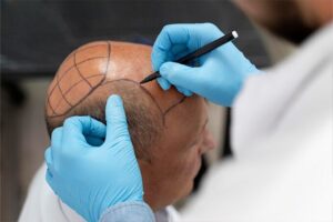 Why Riyadh is a Hub for Hair Transplant Tourism