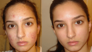 How Affordable Is Acne Scar Treatment in Dubai ?