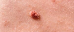 How to Remove Skin Tags on the Inner Thigh: Home Remedies That Really Work