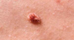 How to Remove Skin Tags on the Inner Thigh: Home Remedies That Really Work
