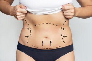 Is Liposuction in Dubai Risky During Hot Weather Recovery?