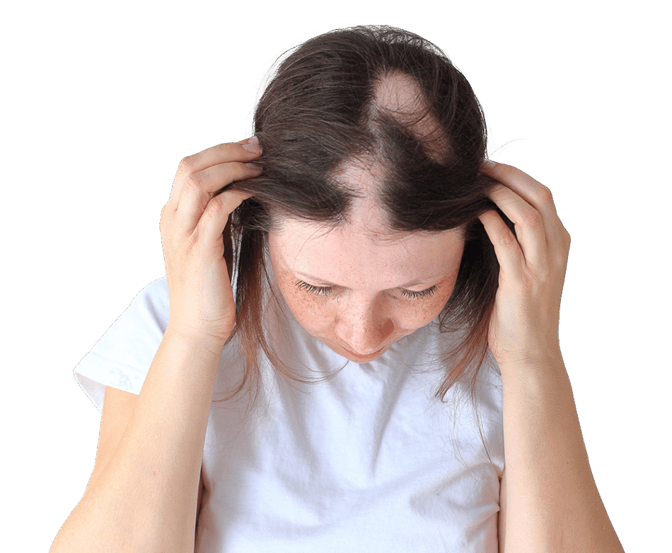 Is Scalp Micropigmentation a Good Option for Alopecia Areata in Dubai?
