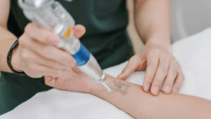 Picosure Tattoo Removal Guide for Fast and Visible Results