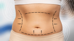 Liposuction: Sculpt Your Body with Precision and Safety