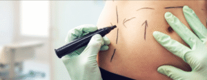 Your Guide to Selecting the Best Liposuction Surgery Clinic in Dubai