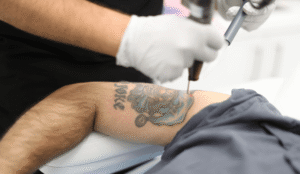 Benefits of Laser Tattoo Removal for Effortless Skin Transformation