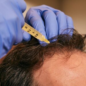 Best PRP Hair Treatment Experts Riyadh