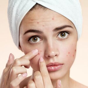 Advanced Pimples Treatments in Riyadh Explained