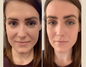 Best Aesthetic Clinic in Dubai for PRP Injection: Unlocking Skin Rejuvenation