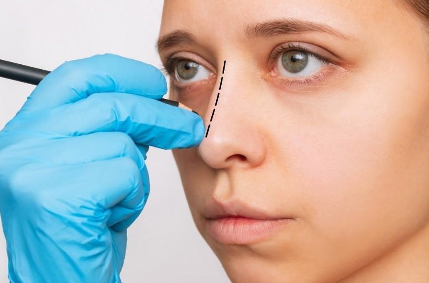 Redefine Your Facial Profile with Expert Rhinoplasty