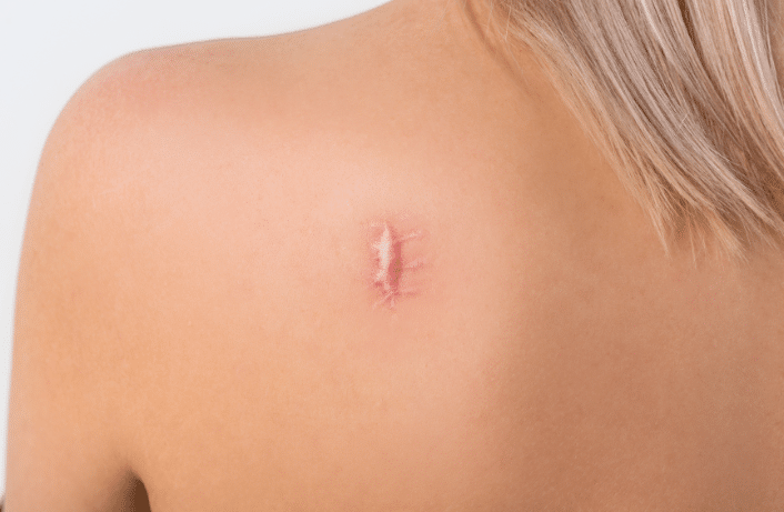 Regain Self-Assurance with Surgical Scar Revision
