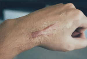 Surgical Scar Revision: Expert Care, Lasting Results