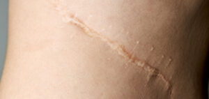 Surgical Scar Revision: Step Into Confidence