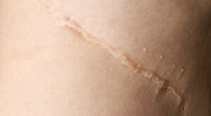 Surgical Scar Revision: Your Step Toward Renewal