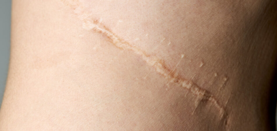 Surgical Scar Revision: Your Step Toward Renewal
