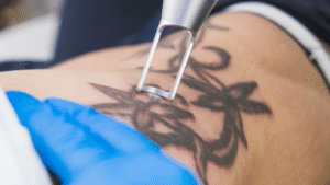 Picosure Tattoo Removal Success Stories That Inspire Confidence