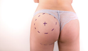 The Complete Patient Journey of Buttock Augmentation