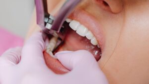 Teeth Extractions in Oshawa: What to Expect Before, During, and After