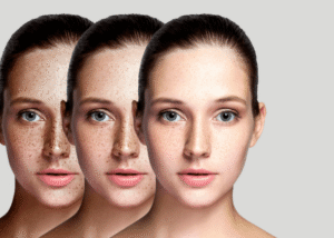 Will Freckle Removal in Dubai Affect My Facial Expression?