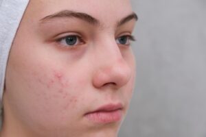 How-to Choose the Right Acne Treatment for Your Skin Type