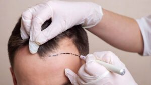 Hair Transplant Options That Offer Fast and Lasting Hair Growth