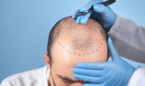 Hair Transplant Tips for Achieving Long-Lasting Hair Confidence