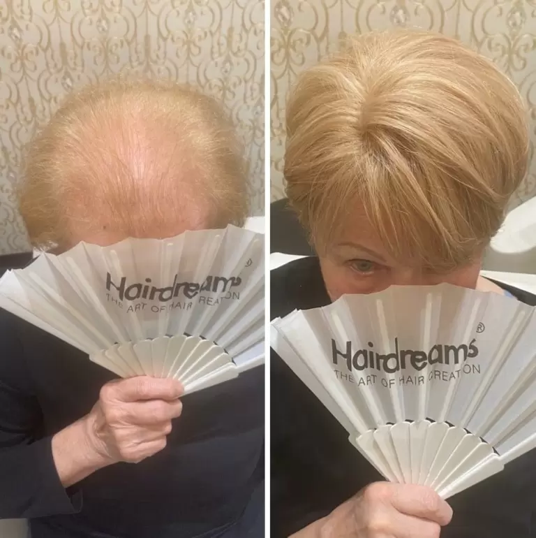 Hairdreams Microlines as a Revolutionary Solution for Thinning Hair