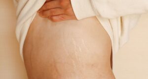 Laser Stretch Marks Treatment