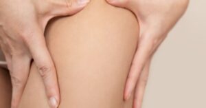 Laser Stretch Marks Treatment in Dubai