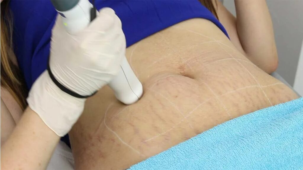 Laser Stretch Marks Treatment