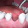 Tooth Extraction