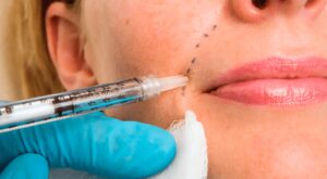 Juvederm Fillers